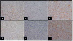 On immunohistochemistry, these large cells are (a) CD20 positive (400x, DAB), (b) CK negative (200x, DAB), (c) CD30 positive (400x, DAB), (d) dim Pax 5 positive (→) (200x, DAB), (e) and EBV LMP negative (400x, DAB). (f) Background macrophages are CD68 positive (400x, DAB)