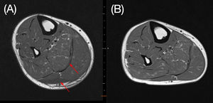 Axial view of lower extremity T1-weighted magnetic resonance imaging (MRI), before (A) and after (B) all-trans retinoid acid withdrawal and dexamethasone therapy. Edema (red arrow) seen in the first MRI (A) can no longer be seen in the second one (B).