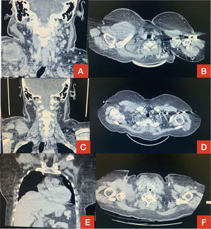 Computed tomography (CT) of the neck in coronal section (A) and CT of the chest in sagittal section (B) showing extensive lesion in the right side in December 2020. Reduction of tumor mass in January 2021 demonstrated on the same CT scans in C and D. Disease progression in March 2021 on chest CT in coronal (E) and sagittal (F) sections.