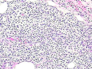 HE 200x. Diffuse lymphoid proliferation with medium-sized cells.