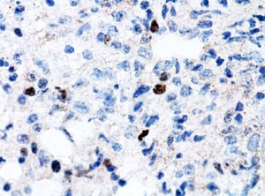 EBER-1. 400x. Marking the nuclei of EBV (Epstein Barr virus) infected B lymphocytes.