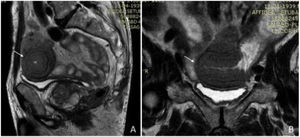 Enteroenteric intussusception with an intraluminal lesion (arrow) in abdominal MRI sagital (A) and coronal (B) views.