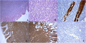 A - Hematoxylin and eosin (HE) staining featuring small bowel with a dense and diffuse lymphocytic infiltrate; B – HE detail of the infiltrate with small lymphocytic cells; C – AE1/AE3 featuring lymphoepithelial lesion; D – Bcl2 positive; E – CD20 positive; F – CD10 negative.