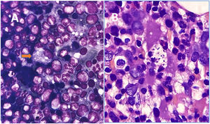 . Giemsa-stained imprint smear shows intracellular Histoplasma sp. in otherwise unremarkable bone marrow (arrow)(1000x) [A]. Bone marrow biopsy of the same patient shows similar intracellular organisms (1000x), the morphological hint being eccentricity of the nucleus. However, the thick cell wall is better appreciated in cytology smears [B].