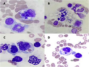 Bone marrow aspirate showing hemophagocytosis by (A) histiocytes, (B) macrophages and (C, D) infiltration with hemophagocytosis by monocytic blasts (Wright-Giemsa stain, 100x).