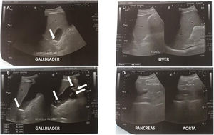 Abdominal ultrasound performed on the 5th day of symptoms. (A and B) Several mobile calculi (from 0.9 to 1.8 cm) were identified inside the gallbladder. White arrows point the calculi. (C) Both liver echotexture and intra- and extra-hepatic canaliculi were normal. (D) Pancreas echotexture was normal.