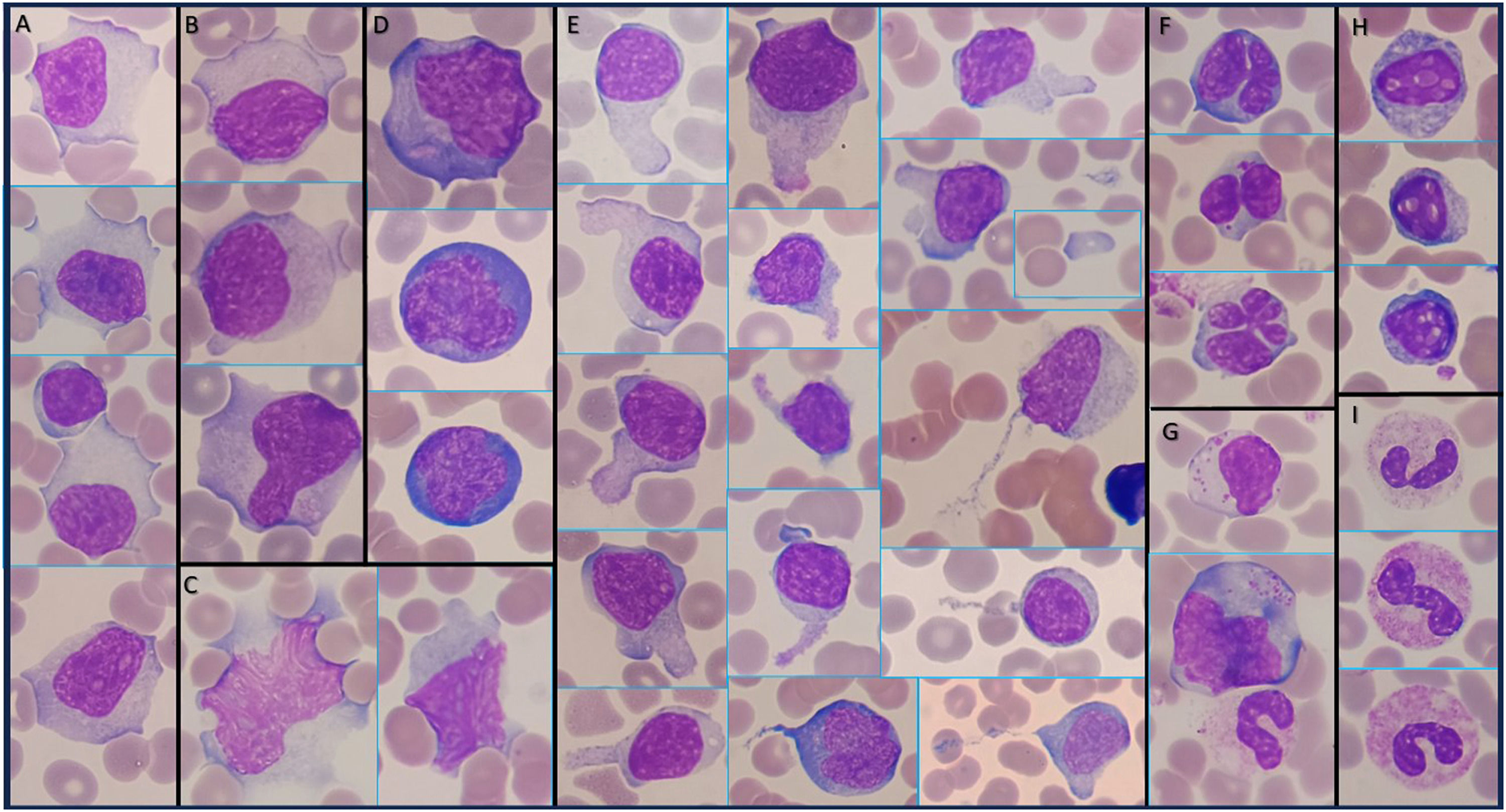Infectious mononucleosis by Epstein-Barr virus: A complete laboratory ...