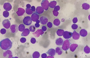 Bone marrow aspirate smear showing infiltration by pleomorphic blasts. May-Grumwald-Giemsa, 1000x.