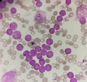 Blast morphology in our case. They are variable sized, high nuclear to cytoplasmic ratio and condensed nuclear chromatin.