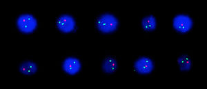 Interphase nuclei showing 1 red and 2 green signals indicating ABL1 deletion.