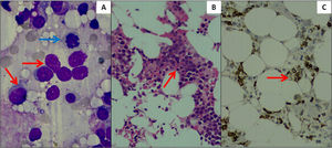 (A) Bone marrow aspitrate smear showing blasts with high N:C ratio (red arrows) along with an erythroid lineage cell showing dyspoietic changes (blue arrow) (MGG, 1000x). (B) Bone marrow biopsy showing hypocellalar marrow with clusters of blasts (H&E, 400x). (C) Immunohistochemistry for CD34 showing positivity in blasts (IHC, 400x).