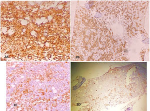 (A) LCA is positive in tumor cells. (B) CD20 highlighted tumor cells with sinusoidal involvement. (C) Tumor cells are MUM1 positive. (D) Ki-67 index around 60% in tumor cells.