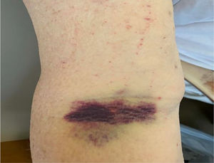 Right antecubital fossa of patient revealing ecchymosis on presentation.