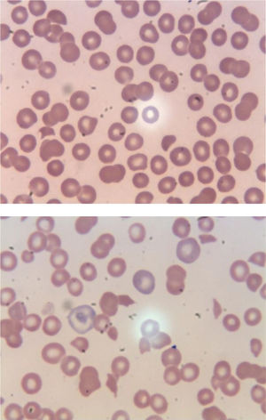 A. Peripheral smear on initial presentation. B. Peripheral smear within hours later from presentation. This peripheral smear is revealing thrombocytopenia, decreased lymphocytes, few schistocytes, target cells, few reticulocytes. This peripheral smear is revealing markedly abnormal cells including thrombocytopenia, lymphopenia, target cells, and abundant schistocytes. Technical aspect: Peripheral smear reviewed using Microscope Olympus BX45, 100x (oil) * ten magnification used, Leica microsystems software used to acquire images.