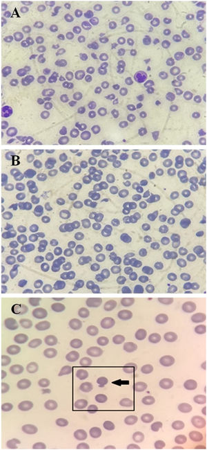 Photomicrograph of a panoptically stained blood smear from the patient at the time of imaging (A) showing severe microcytosis, hypochromia, polychromasia, schizocytes, and mushroom-shaped red cells; and after clinical remission (B). Mushroom-shaped cells are also highlighted in (C). All images are magnified 1000 times.