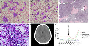 A. Peripheral blood smear showed a low amount of red blood cells and platelets, with a high amount of white blood cells, with 30% blasts. B. The bone marrow aspiration showed a hypercellular marrow, with 67% blasts. C. The bone marrow biopsy also showed a hypercellular marrow (H&E stain, original magnification × 100). D. Immunohistochemistry staining showed CD34 (+) 7%, CD3 (+) 10%, TdT (+) 20%, CD20 (+) < TdT(+), CD117 (+) 20%, PAX5 (+) > TdT (+), CD1a (+) 5%, CD10 (+) 10%, MPO (+) 15% and CD33 (+). E. The head CT scan showed new subdural hemorrhages on both temporal lobes (red arrow). F. The patient leukocytes graph from admission to discharge.