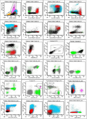 The flow cytometry analysis on bone marrow showed distinguished populations, including B-lymphoblast: 9% (black population) (CD45inter CD34+ CD10± TdT− CD19+ CD20± CD66c− CD123− CD13± CD38±), Myeoblasts: 7% (red population) (CD45inter CD34+ CD117± HLA-DR+ CD13+ CD33+ CD7± MPO− CD15− CD38±), T lymphocytes: 13% (grey population) (CD45inter-bright CD34− CD10− CD7+ CD1a+ CD3– CD2+ CD5+ CD4+ CD8– CD56− CD57−), Monocytes: 52% (blue population) (CD45bright CD34− CD117− MPO− HLA.DR+ CD64± CD14± CD15− CD36± CD4±). Mature myeloid cells 9.5% (pink population). Red blood cells and debris 4.5% (yellow population).