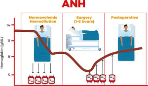 The acute normovolemic hemodilution process in the preoperative period. ANC: Acute normovolemic hemodilution. Source: https://medicine.okstate.edu/gme/quality-symposium/posters-2022/poster-23.pdf