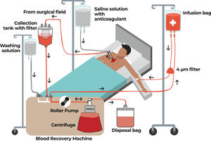 Schema of the components used in the intraoperative autotransfusion recovery technique Adapted from https://www.cardiosurgerypost.com/single-post/autotransfusao-intra-operatoria