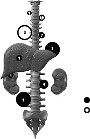Schematic illustration of the general anatomic distribution and number of cases of extramedullary haematopoiesis masses in patients with thalassemia major (black circles) and thalassemia intermedia (white circles).