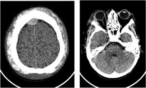 CT showing an frontoparietal epidural hematoma, extensive subgaleal hematoma and bilateral ocular proptosis.