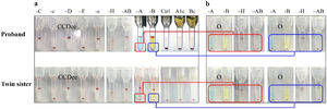 Serological investigation of blood group phenotypes. (a) Analysis of ABO and Rh phenotypes. Mixed field (MF) for ABO in proband and her twin sister. A1c (A1 cell) and Bc (B cell) were used for ABO reverse phenotyping. (b) ABO phenotypes after cell separation from the MF, indicating that the presence of O and AB phenotypes red blood cell (RBCs) in both twins.