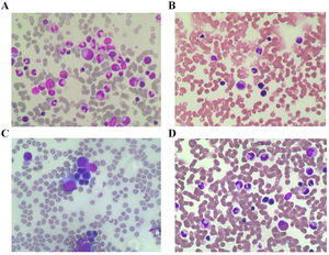 The bone marrow aspiration at the time of hospital admission, in A) Case 1 B) Case 2 C) Case 3 and D) Case 4. The images show no abnormalities.