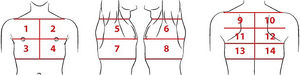Lung areas to be scanned in each lung ultrasound exam. Regions 1 and 2: upper on the midclavicular line above the internipple line. Regions 3 and 4: basal on the midclavicular line below the internipple line. Regions 5 and 6: upper on the midaxillary line above the internipple line. Regions 7 and 8: basal on the midaxillary line below the internipple line. Regions 9 and 10: upper on the paravertebral line. Regions 11 and 12: middle on the paravertebral line. Regions 13 and 14: basal on the paravertebral line, above the curtain sign.