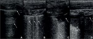 A. Lung ultrasound obtained with linear probe showing continuous and regular pleural line (continuous arrow) and presence of A-lines (dashed arrow), horizontal hyperechogenic artifacts due to the high reflectivity of the normally aerated lung. B: Lung ultrasound obtained with linear probe, showing presence of B-lines (continuous arrows), vertical white lines, due to alterations in the acoustical properties of the lung, representing the partial replacement of air in the alveolar space by fluid. C: Lung ultrasound obtained with linear probe, showing a small consolidation (continuous arrow), associated with hyperechogenic areas below (dashed arrow), representing the loss of aeration of lung parenchyma. D: Lung ultrasound obtained with linear probe, showing a larger consolidation (continuous arrow) and hyperechogenic area below, associated with a small pleural effusion (dashed arrow).