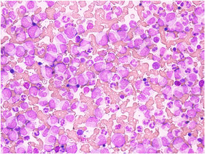 Peripheral blood smear showing leukocytosis with myelocyte bulge, blasts, basophils, promyelocytes, metamyelocytes, bands, eosinophils and monocytes suggestive of chronic myeloid leukemia likely the chronic phase.
