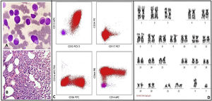 A: Bone marrow aspirate show many promonocytes and abnormal monocytes, B: Marrow trephine biopsy show sheets of promonocytes and monocytes, C: Flow cytometry dot plots show abnormal monocytic population expressing CD33 (moderate), CD13 (variable), CD64 (moderate), CD36 (subset), CD14 (variable) and negative for CD34 and CD117. Normal T cells (pink) are also seen, D: Representative karyotype of a metaphase cell showing 46,XY,?t(9;11)(p22;q23)[20].