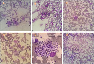 Bone marrow changes seen under light microscopy (100x). A. Scarce bone marrow parasitism. B. Mott