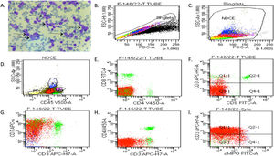 The clinical diagnosis of T-ALL patients was confirmed by peripheral blood and bone marrow tissues. (A) Representative images of Leishman staining of the blood of T-ALL patients, in which the majority of cells were in the blast crisis phase (arrows show blast cells). (B-I) Flow cytometry results show the blast cells in T-ALL patients, which were plotted on CD45 with side scatter and plotted on the marker and marker vs. marker for the confirmation of T-ALL. Blast cells were gated on CD45 vs. side scatter. The expressions of T-lymphoid markers (CD3, cytoplasmic CD3, CD2, CD5, CD7) and immaturity markers (CD34, TdT, HLA-DR) were studied.