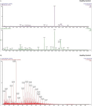 Label-free screening of differential proteins in T-ALL by using liquid chromatography-tandem mass spectrometry (LC-MS/MS). (A) shows the integrity of proteins isolated from healthy controls and T-ALL patients (Lanes 1–4 show healthy controls, and Lanes 5–9 show T-ALL patients), whereas (B-I) shows protein estimation, which was analyzed by the bicinchoninic acid kit. (J-M) shows the LC-MS/MS spectra of healthy controls and T-ALL patients. (N-P) shows 35 differentially expressed proteins in healthy controls and T-ALL patients, whereas the heatmap also shows the overall cumulative differential expression of proteins expressed in both groups. (Q) Nine signature proteins were found only in T-ALL patients and not in healthy controls.