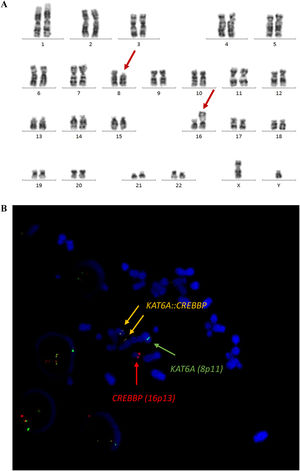 Cytogenetic findings. (A) Karyotype analysis: 46,XY,t(8;16)(p11.2;p13.3) (B) FISH Probe Kit Translocation analysis using Dual Fusion KAT6A-CREBBP CytoTest: KAT6A (green)/CREBBP (red) showing 2 fusion signals (orange), indicating ish t(8;16)(KAT6A+,CREBBP+;CREBBP+,KAT6A+) rearrangement.