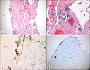 A cell block preparation from the pleural effusion revealed scattered atypical cells floating around and within fibrinous material A (H & E - 100×). The cells had plasmablastic appearance, with large eccentric vesicular nuclei, prominent nucleoli and basophilic cytoplasm B (H & E - 400×). By immunohistochemically, cells were positive for CD138 C (anti-CD138 - 400×) and HHV-8 (not shown). Chromogenic in situ hybridization for EBV- encoded RNA was also positive in this specimen D (EBER CISH - 400×) supporting the diagnosis of Primary effusion lymphoma.