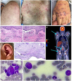 Clinical presentation of dermatological lesions: (A) livedo, (B) erythematous papules on the trunk and upper arms, (C) erythematous-purpuric infiltrated papules and nodules composing Sweet syndrome-like dermatosis. (D) & (E) Hematoxylin and eosin-stained sections of the skin biopsy specimen show a diffuse infiltrate of lymphocytes and neutrophils with leukocytoclasis in absence of eosinophils. There is evidence of vasculitis in superficial and deep vessels, fibrin deposits in the vascular wall, nuclear debris, and erythrocyte leakage. Bacterial, mycobacterial, and fungal cultures were negative. (F) 18F-fluorodeoxyglucose (FDG) positron emission tomography (PET-CT). (G) Auricular chondritis. (H) Hematoxylin and eosin-stained auricular biopsy specimens show lymph histiocytic infiltrate predominantly in the deep dermis with absence of vasculitis. (I) Bone marrow aspirates with myelodysplastic syndrome and vacuolated myeloid progenitor.