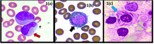 (a) Peripheral blood smear (PBS): blast/abnormal promyelocytes with salmon-pink cytoplasmic granules (red arrow). (b) PBS: blasts with strong cytochemical myeloperoxidase staining (black arrow - 40x). (c) Bone marrow aspirate: blasts with prominent Auer rods and faggot cells. (blue arrow - 40x).