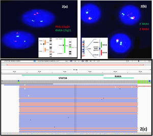 Cytogenetic and molecular genetic test findings. (a) Fluorescence in situ hybridization (FISH): PML::RARα dual color dual fusion probe: 2G2R - one weak green signal. (b) FISH:RARα break-apart probe: 1F1 G signal indicating deletion of areas distal to 3´ of RARα gene (interphase nuclei). (c) Integrative Genomics Viewer (IGV v2.11.2) showing STAT5B::RARα gene fusion on Ion Torrent Oncomine Myeloid Research Assay® (NGS) performed using the Ion GeneStudio™ S5 system.