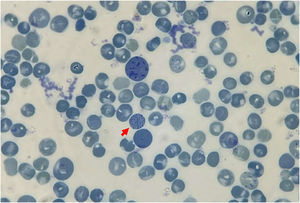Formation of red blood cell inclusion bodies induced after incubating red blood cells with 1% brilliant cresyl blue for 3 h. Blue golf-ball-like formations (red arrows) are observed in the patient.