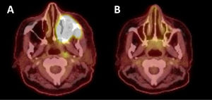 A) Positron emission tomography – computed tomography (PET-CT) scan demonstrating extramedullary disease prior to bridging and CAR T cell therapy B) PET-CT scan demonstrating response to bridging and CAR T cell therapy.
