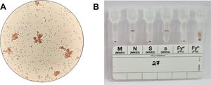 Serological typing of ACKR1 antigen. A. Standard serological typing of ACKR1 antigen using tube method. Weak to very weak agglutination reaction was observed under (X10) microscopic field. B. Validation of tube method of ACKR1 investigation using Diamed gel cards showing no agglutination reaction (Fya) and weak agglutination reaction (Fyb).