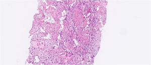 Fibrinous and organizing interstitial pneumonia with neutrophilic exudate - histological sections of the lung parenchyma showing moderate to severe exudate fibrinoleukocyte with frequent neutrophils and areas of neutrophilic debris. Presence of fibrinoid aggregates in organization in the alveolar spaces, with histiocytes containing hemosiderin. Pulmonary interstitium with mild edema and immature fibroplasia (focal myofibroblastic aggregates). No granulomas or malignancy were identified in the sample. Acid-resistant bacilli, bacteria and fungi by Ziehl-Neelsen stains, Brown-Breen, PAS and Grocott were negative. The immunohistochemical investigation of Herpes, CMV and Adenovirus viruses, resulted negative.