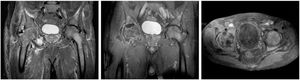 Magnetic resonance imaging of the pelvis showing avascular necrosis of the right femoral head, chondral thinning and narrowing of the right hip joint space, large right hip joint effusion with distension of the articular recesses and capsular enhancement after contrast administration; in addition to edema in the gluteal muscles and the proximal right thigh, along with signs of bone marrow infiltration of the pelvis, sacrum, studied vertebral bodies, and bilaterally of the femurs.