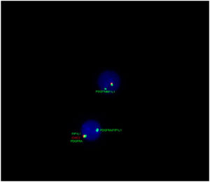 Fluorescence in situ hybridization for 4q12 (FIP1L1/PDGFRA) on chromosome 4 - rearrangement of FIP1L1-PDGFRA was detected in 98 % of the analyzed nuclei.