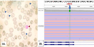 A) Peripheral blood smear (Leishman Giemsa stain, 100x) of a 12-year-old girl with hemolytic anemia showing stomatocytes (blue arrow head) and large platelet (red arrow head); B) Integrative genomics viewer visualization of alignments in chromosome 2 is showing C > A variation corresponding to ABCG8:c.691C>A;p.(Pro231Thr).