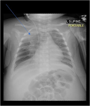 Chest radiograph showing the right sided infiltrate indicative of pneumonia (arrow).
