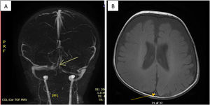 Brain magnetic resonant venogram (MRV) showing non-occlusive dural venous thrombosis of the sinus confluence and the left transvers sinus to involve superior sagittal sinus A; coronal and B; axial plane.