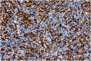 Tissue microarray spot - immunoexpression of CD163 (2000x).