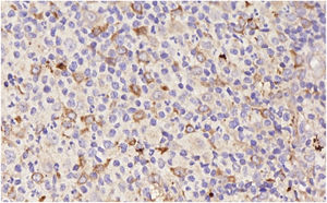 Tissue microarray spot - immunoexpression of CXCR-5 (2000x).